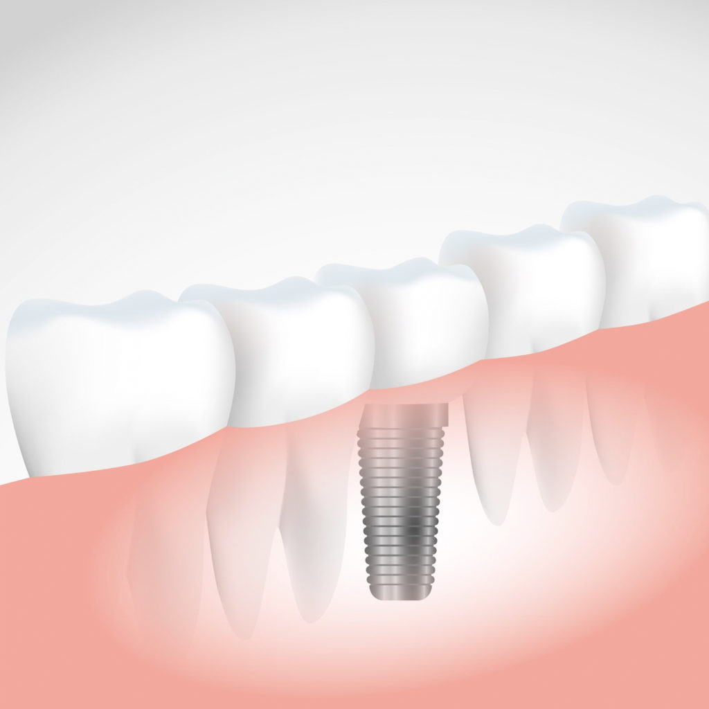 La falta d'una dent pot provocar problemes en la boca com alterar la posició de les dents, dificultar la higiene i ocasionar un major desgast de la resta de peces dentals.